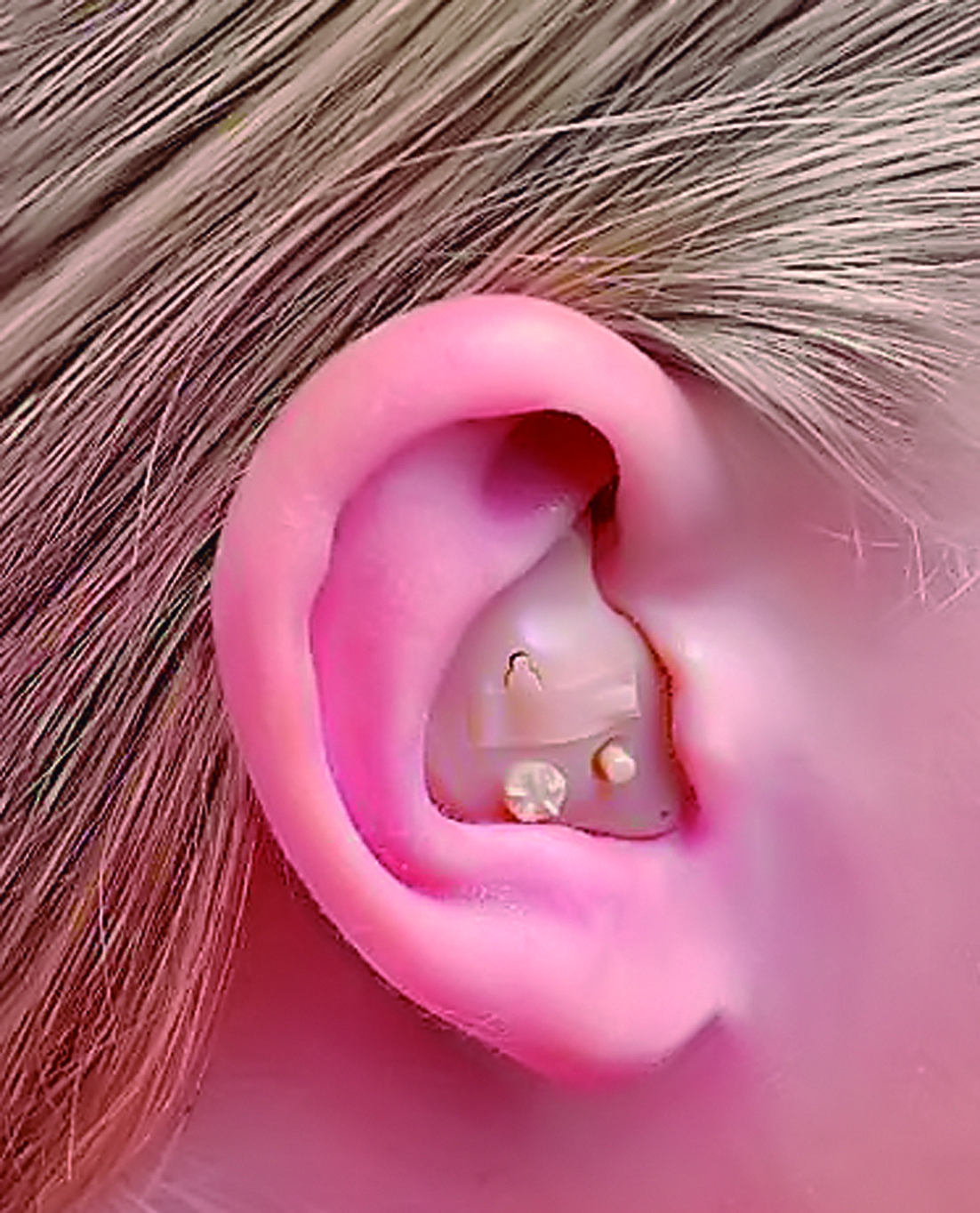 Audífonos intrauriculares (dentro del oído)