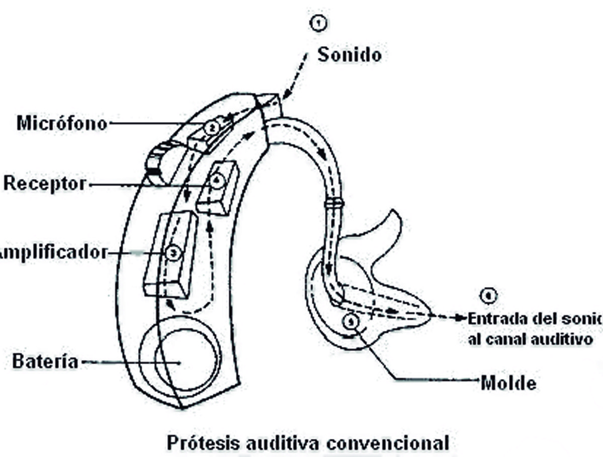 Las partes de un audífono y su funcionamiento